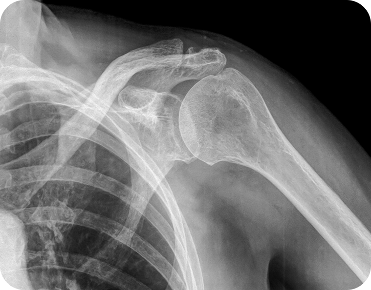 X-ray 뼈 사진